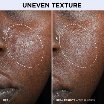 uneven texture 