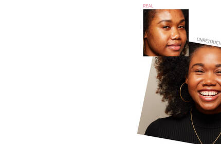 Before-and-after photos of a woman with curly hair showing real, unretouched skin improvement and a bright smile.