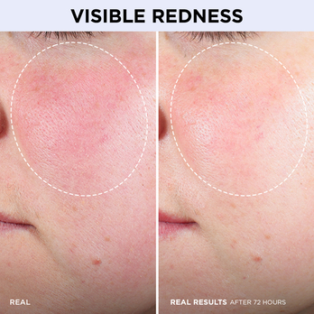 visible redness