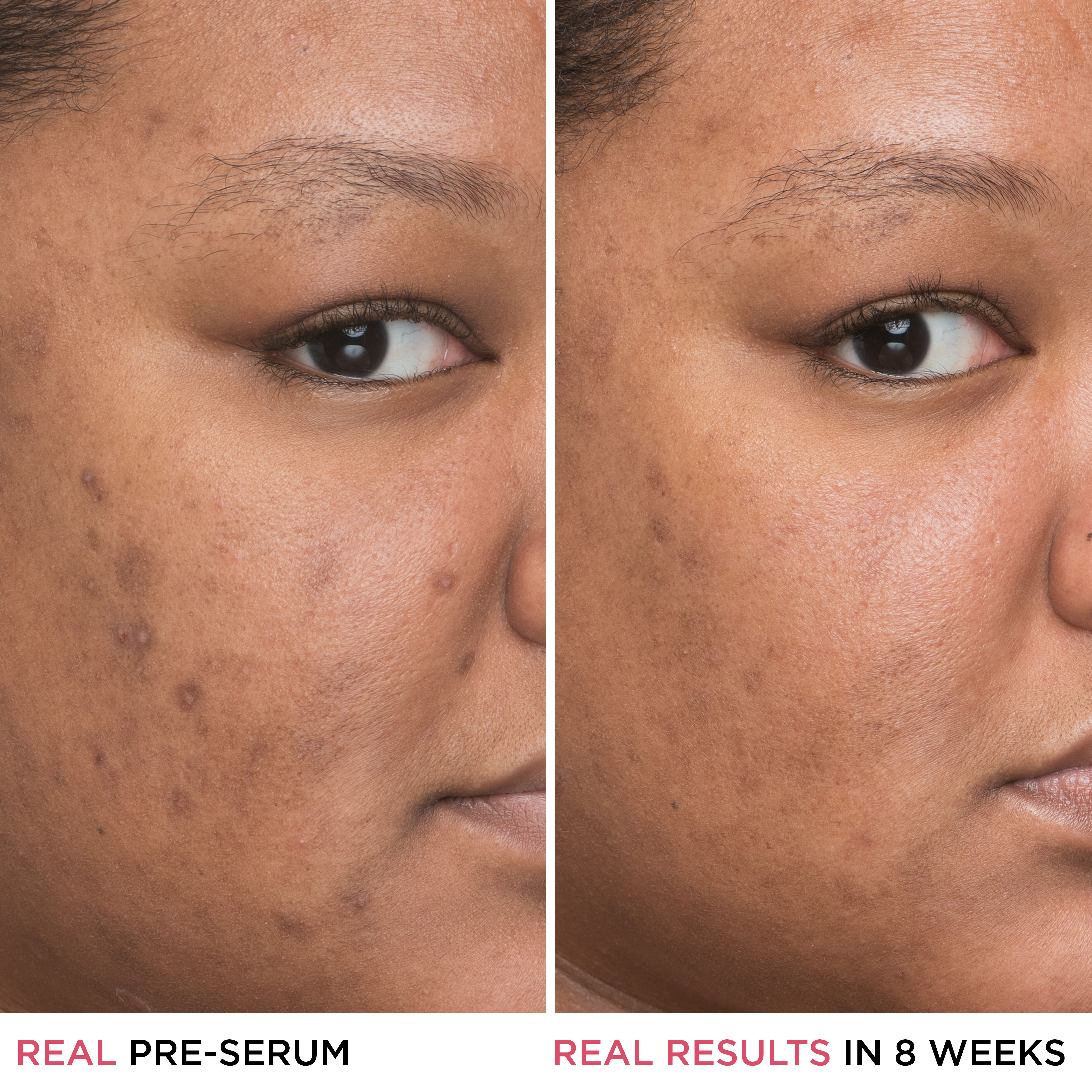 Bye Bye Dark Spots 4% Niacinamide Serum