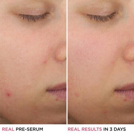 Bye Bye Breakout 2% Salicylic Acid Serum