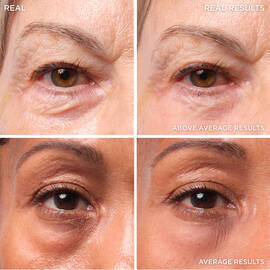 Bye Bye Under Eye Bags Treatment
