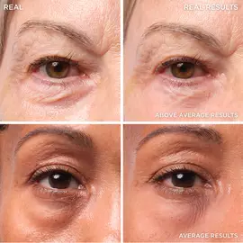 Bye Bye Under Eye Bags Treatment